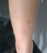 Varios niños afectados por una plaga de pulgas en el parque de La Roldana
